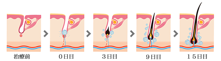 毛髪再生医療