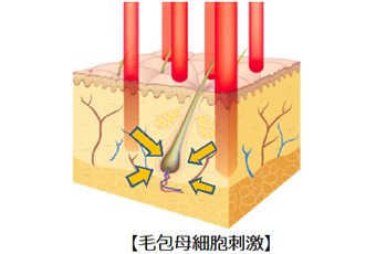レーザー育毛