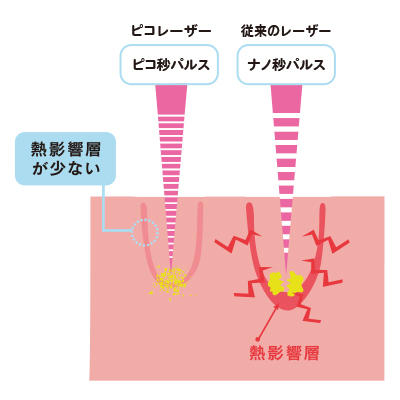 ピコレーザー