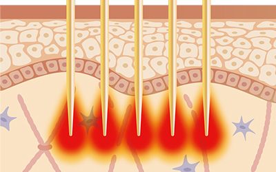マイクロニードルRF（シルファームX）