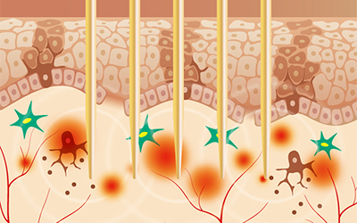 マイクロニードルRF（シルファームX）